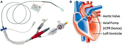 Case report: Cytokine therapy and an intracoronary autologous bone marrow-derived cell infusion with Impella support in a patient with dilated cardiomyopathy and a severely reduced ejection fraction